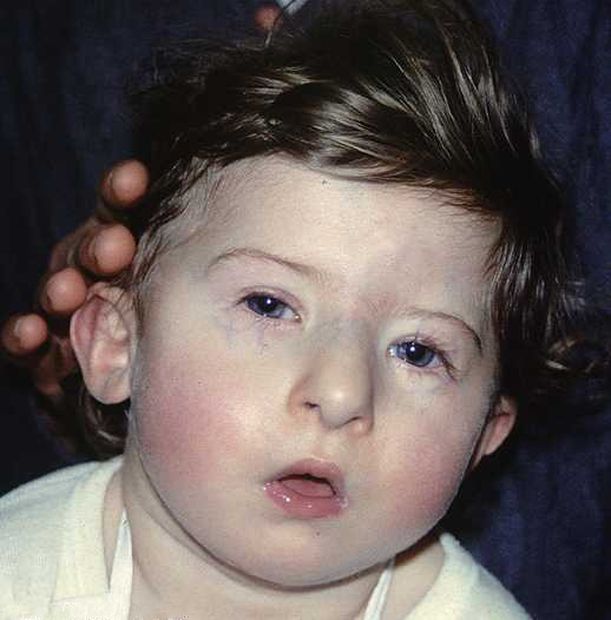 El Síndrome 22q11.2 altera la posición de los ojos, orejas y nariz. Foto: Naukas