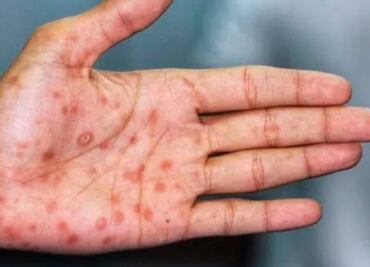 Zacatecas confirma primer caso de viruela del mono