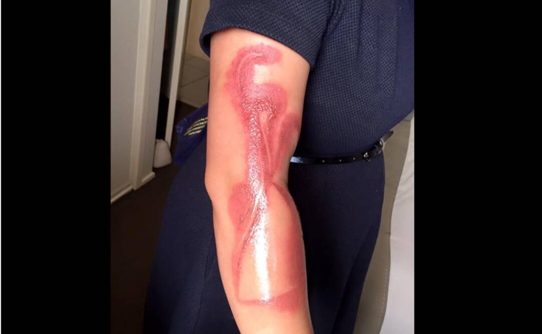 Mujer sufre quemadura en el brazo por iPhone 7
