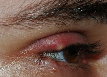 ¿Qué es el tracoma?