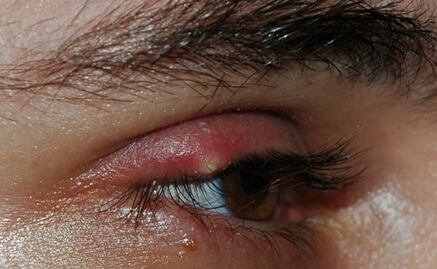 ¿Qué es el tracoma?