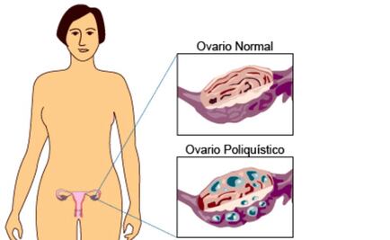 Análisis de sangre detecta 86% de cánceres de ovarios