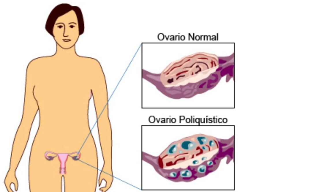 Alrededor de 7 mil 100 mujeres son diagnosticadas cada año con cáncer de ovarios en el Reino Unido. Foto: Archivo EL UNIVERSAL
