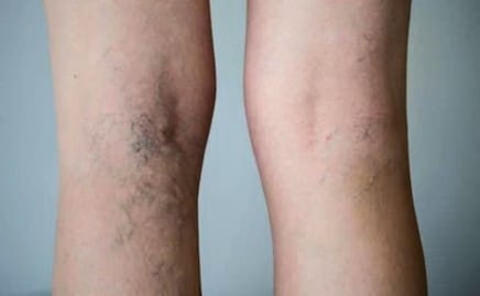 Este es el superalimento ideal para combatir las varices y limpiar las arterias