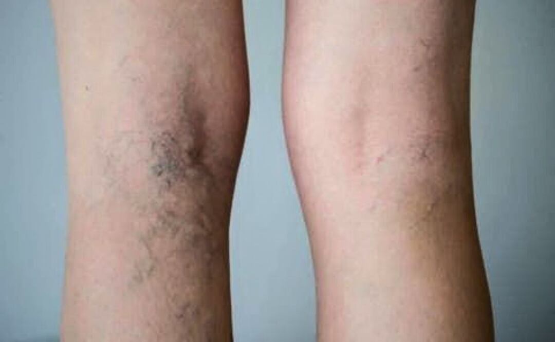 Ajo para las várices. Fuente: Pinterest