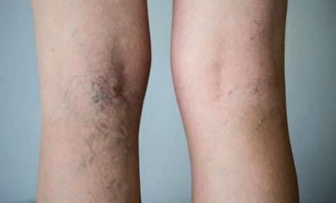 Ajo para las várices. Fuente: Pinterest