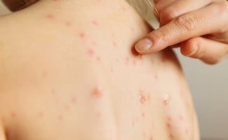 Sarampión en México: ¿qué remedios existen para reducir los síntomas?; esto se sabe