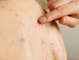 Salud reporta 74 casos de sarampión activos en nueve estados de México; suman 5 mil 153 en el 2025