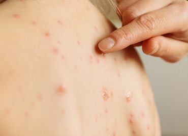 ¿Qué es y cuáles son los síntomas del sarampión?; Conave emite aviso epidemiológico por 21 casos en México