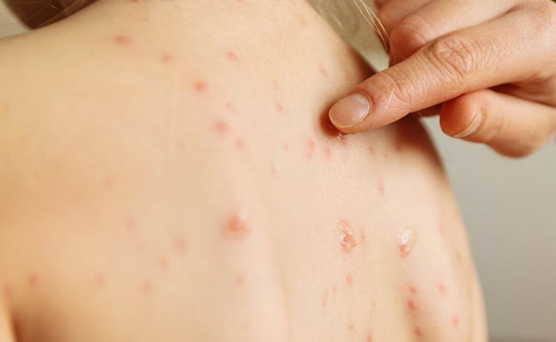 El sarampión es una enfermedad vírica muy contagiosa que afecta sobre todo a los niños. Foto: EL UNIVERSAL