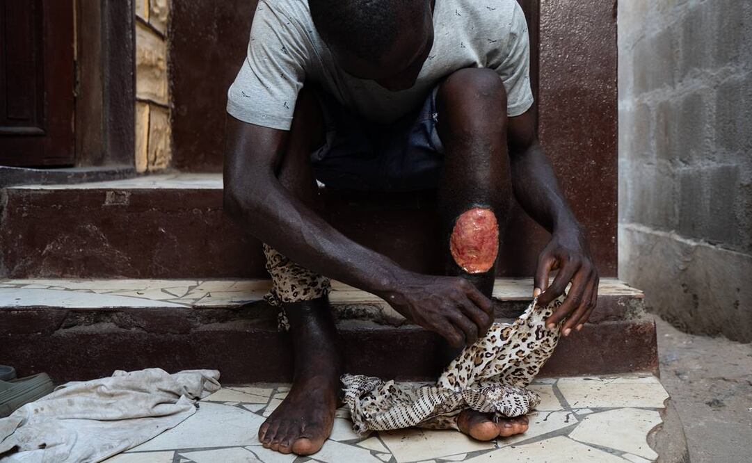 Solomon, un adicto a la 'kush' de 27 años, está sentado con las piernas vendadas e hinchadas por el abuso de la kush en Freetown, Sierra Leona. Foto: EFE