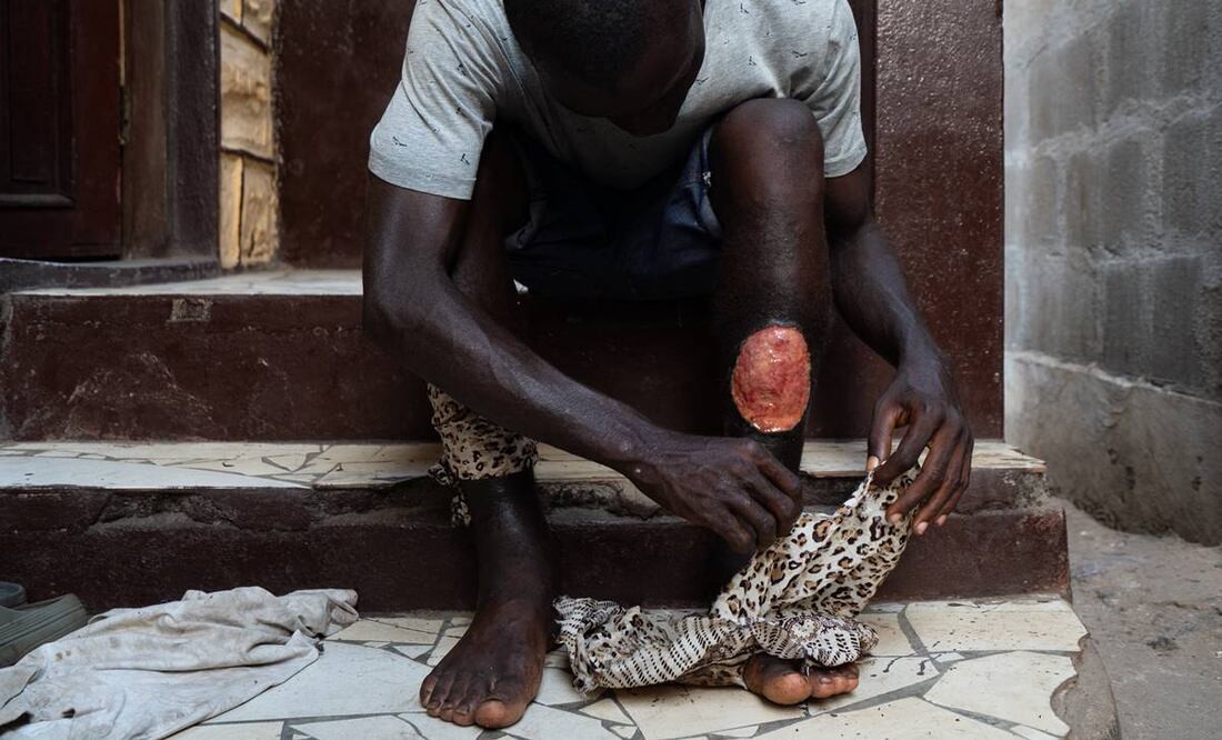 Solomon, un adicto a la 'kush' de 27 años, está sentado con las piernas vendadas e hinchadas por el abuso de la kush en Freetown, Sierra Leona. Foto: EFE