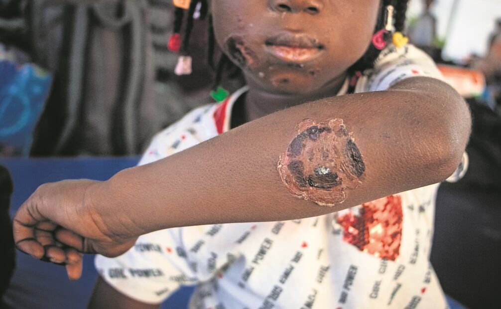 En su difícil travesía su cuerpo presenta secuelas de hambre, enfermedad, accidentes e insolación, Foto: Gabriel Pano