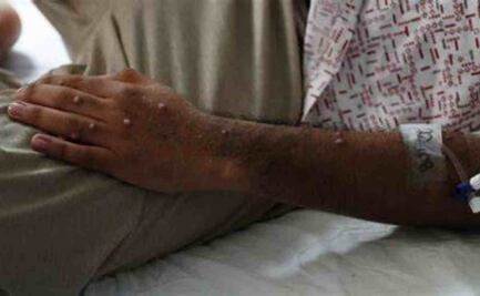 OMS levanta la emergencia sanitaria internacional por mpox; registran descenso de casos