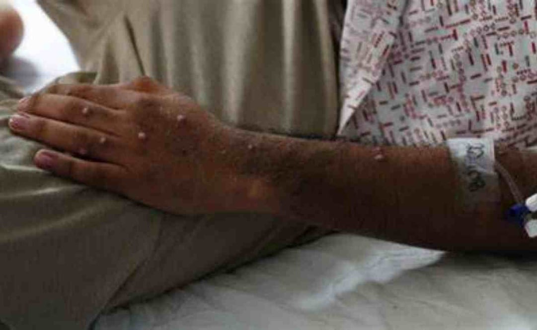 Levanta la emergencia sanitaria internacional por la mpox. Foto: Especial