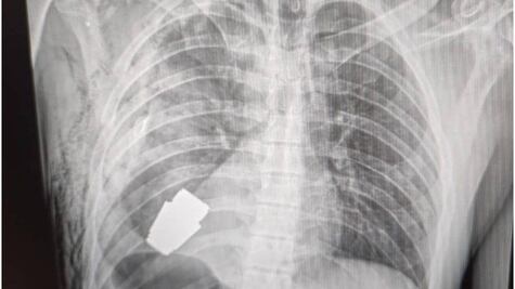 La arriesgada operación para sacarle una granada del pecho a un soldado ucraniano sin que explotara