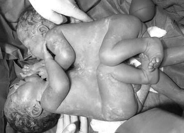 Médicos del IMSS separan a siameses unidos por tórax y abdomen