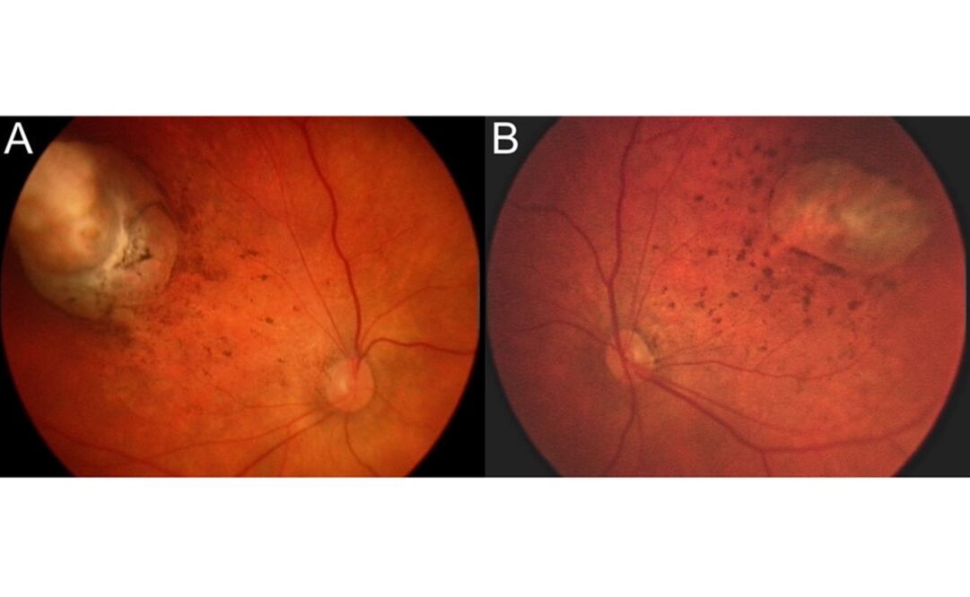 Esta combinación de imágenes muestra anormalidades en el fondo de los ojos de un bebé diagnosticado con microcefalia debida posiblemente a una infección congénita con zika (Foto: AP)