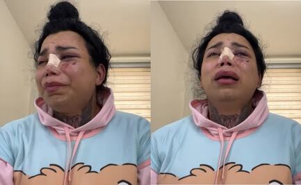 Paola Suárez confiesa aún querer a su novio pese a agresión; "el amor no se termina de un día para otro"