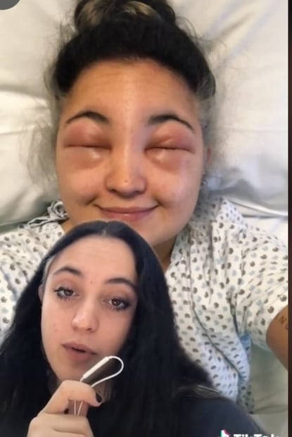 Mujer se pinta el pelo y le causa alergia: mira lo que pasó