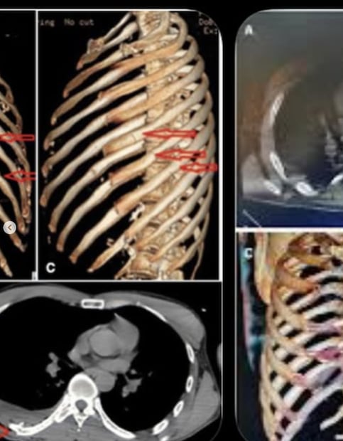 Corey Harrison muestra las secuelas del accidente de moto que sufrió en México: 11 costillas fracturadas.