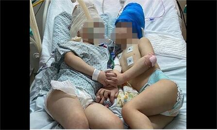 Fotos. Logran con éxito separación de siameses unidos por la cabeza en Brasil