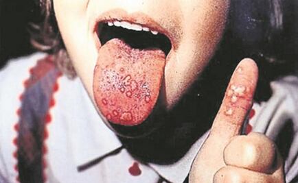 Registra Oaxaca 376 casos de coxsackie en lo que va del año