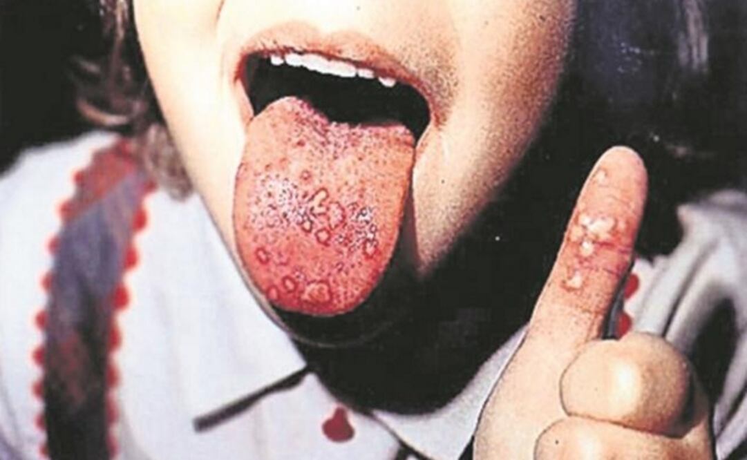 Registra Oaxaca 376 casos de coxsackie en lo que va del año 