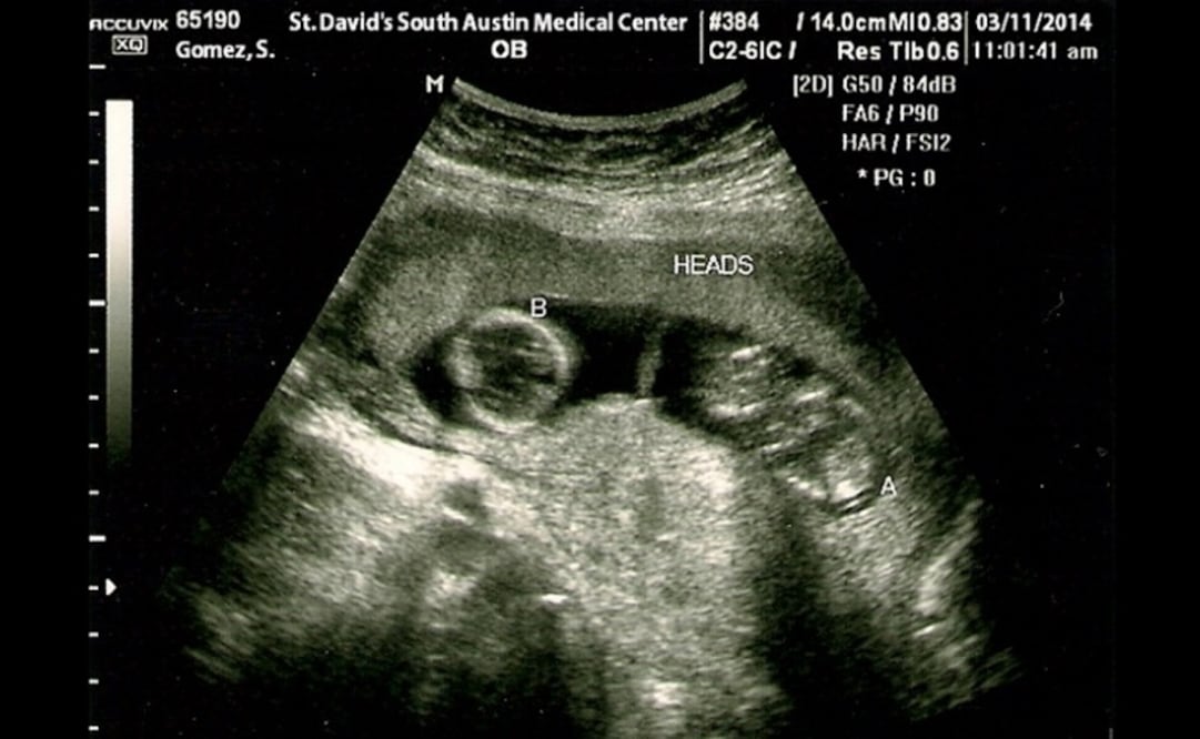 This method allows for a very precise treatment of the fetal heart rate, which is of very low amplitude - Photo: File photo/EFE