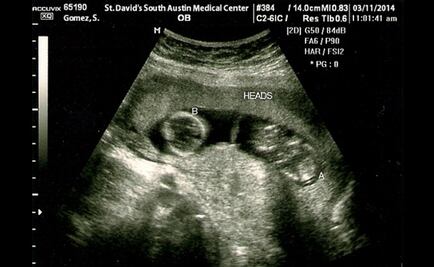 Fetal monitoring device developed by Mexican scientists