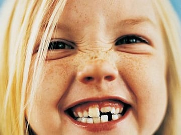 Caries en dientes de leche causa estragos en dentadura permanente