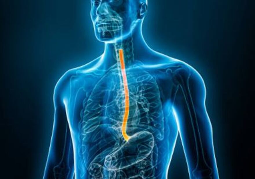 ¿Qué es el cáncer de esófago?. Foto: Pixabay