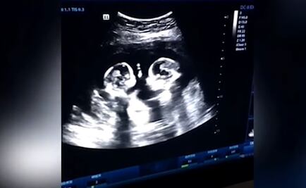 Captan a gemelas "peleando" en el útero de su madre en China