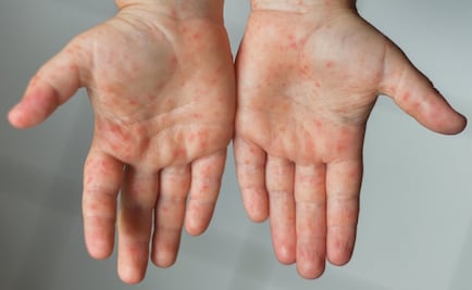 Alerta OMS y CDC de una "amenaza inminente por sarampión" tras casos de Covid-19