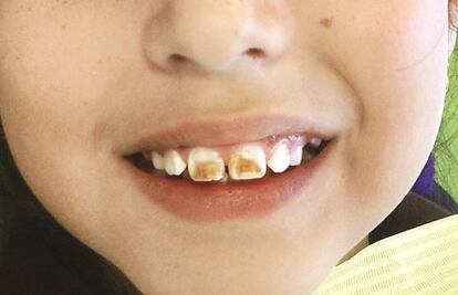 Fluorosis dental: arduo problema de salud pública