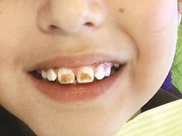 Fluorosis dental: arduo problema de salud pública