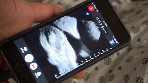 El revolucionario invento para hacerte un ultrasonido desde el celular