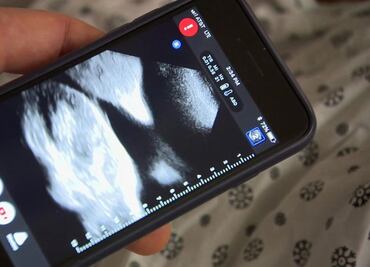 El revolucionario invento para hacerte un ultrasonido desde el celular