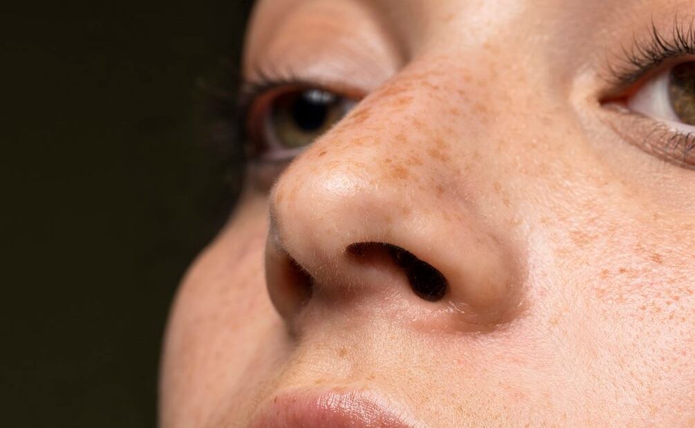 Acude a un especialista en dermatología para tratar las manchas de la cara. Foto: Freepik