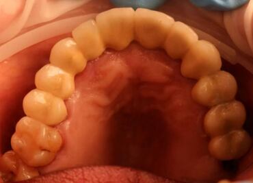 Descubren cómo es que los dientes perciben el frío