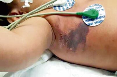 “Hay mal diagnóstico sobre araña violinista”