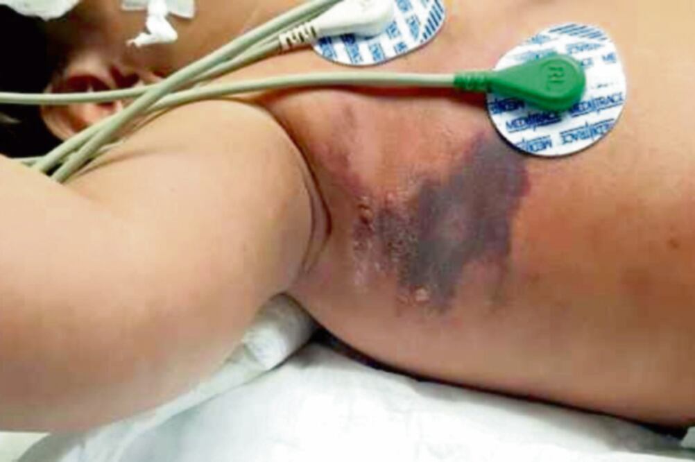 Autoridades sanitarias de Tepic dijeron que cuando obtuvieron el medicamento contra el veneno de la araña violinista, el niño Kevin Caaño, quien fue mordido por una de éstas, tenía comprometida la circulación en varias partes de su cuerpo (CORTESÍA)