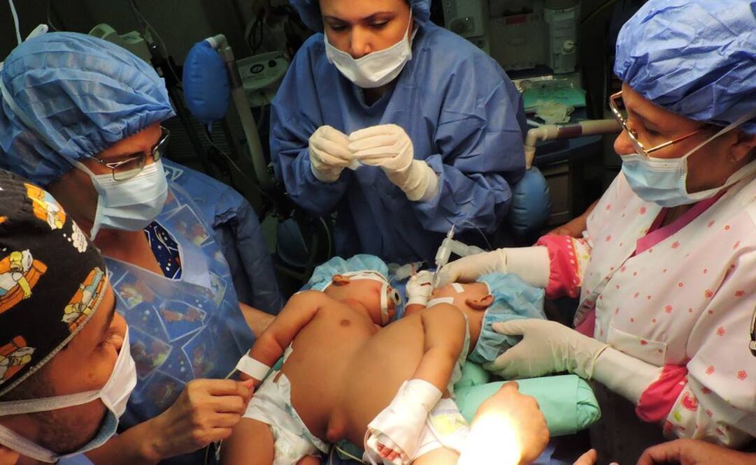 Las gemelas Pertuz fueron separadas el pasado jueves por 22 especialistas del Servicio Autónomo Hospital Universitario de Maracaibo. Foto: AFP