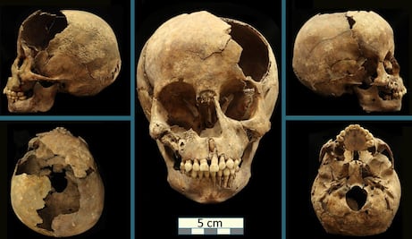 El origen de la sífilis se remontaría a la época prehispánica: estudio