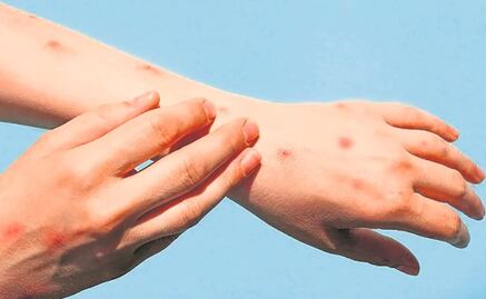 Edomex registra dos casos de viruela del mono