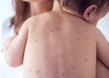 ¿Qué es la escarlatina, enfermedad que tiene en alerta a los niños de México por aumento de casos?