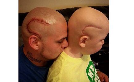 Padre se tatúa cicatriz en apoyo a su hijo con cáncer