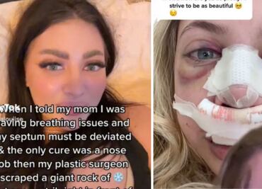 Convence a su madre para pagarle cirugía plástica en la nariz, descubrimiento se vuelve viral