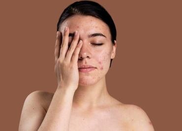 Conoce 3 mitos sobre el acné