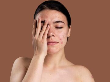 Conoce 3 mitos sobre el acné